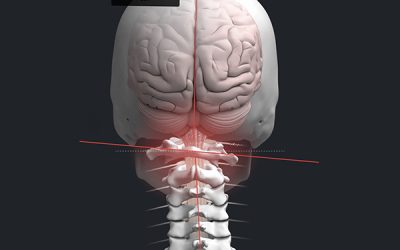 O que é Subluxação Vertebral?