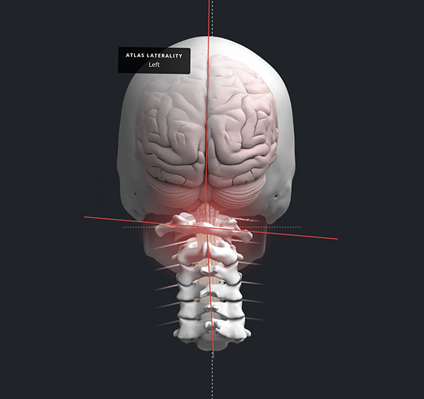 O que é Subluxação Vertebral?